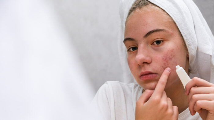 Fiatal lány súlyosan pattanásos bőrét kezeli