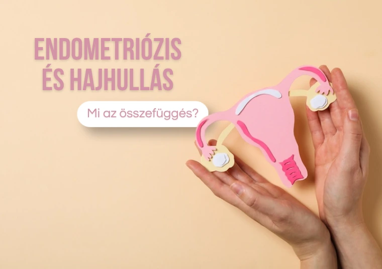 Endometriózis és a hajhullás – Van köztük összefüggés?